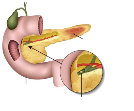 Pankreatitis ass eng Entzündung vun der Bauchspaicheldrüs